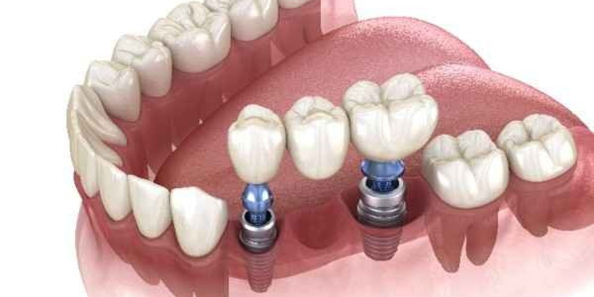 Latest Innovations in Dental Implant Technology