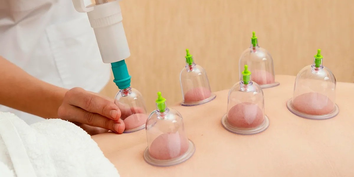 Detox and Energize Naturally Using Ancient Hijama Cupping Therapy