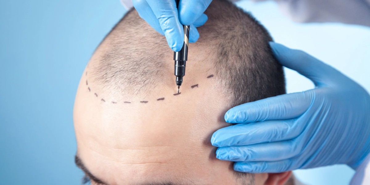 Mini Hair Transplants: Are They a Good Option?