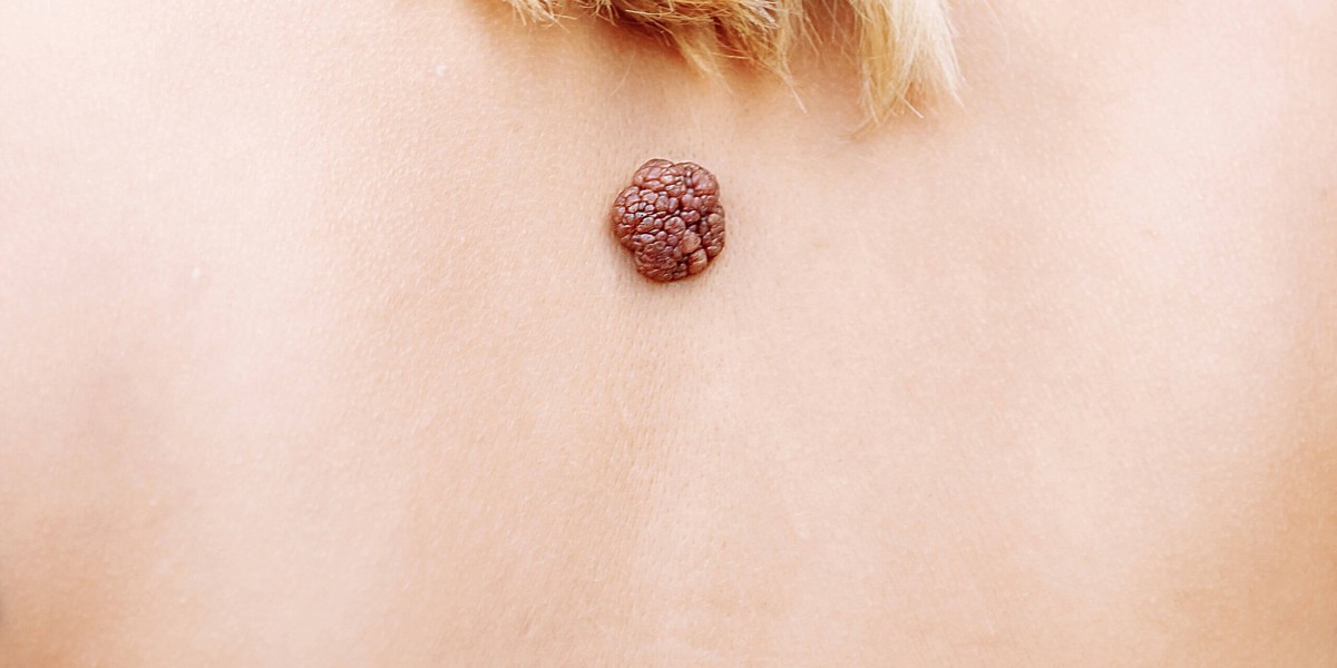 Is Laser Treatment Effective for Removing Stubborn Warts?