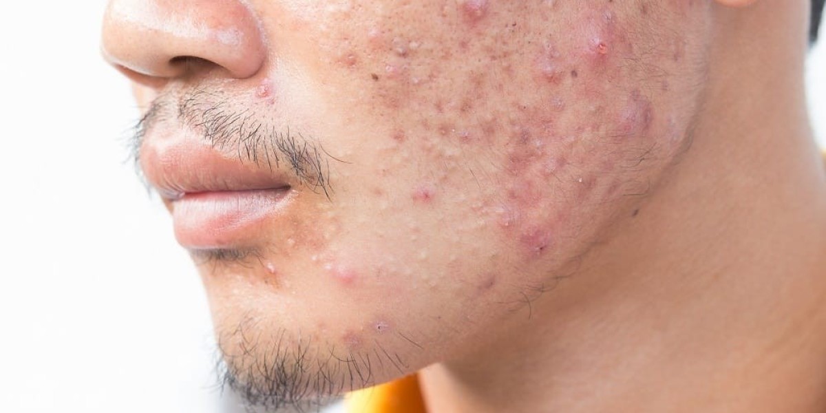 Large Pores Treatment Cost That Helps Skin Look Bright and Clear