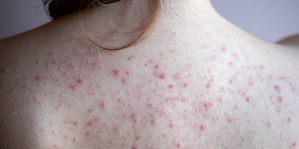Can Shingles Be Controlled Successfully With Medical Treatment?