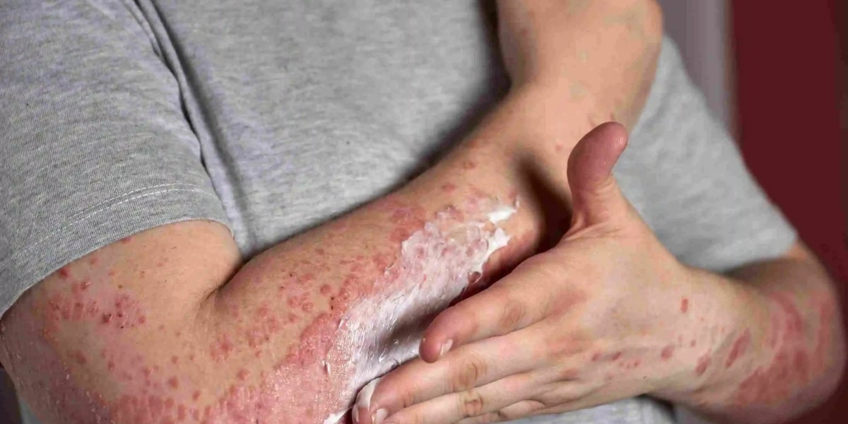 Can Advanced Eczema Treatment Improve Skin Comfort and Confidence?