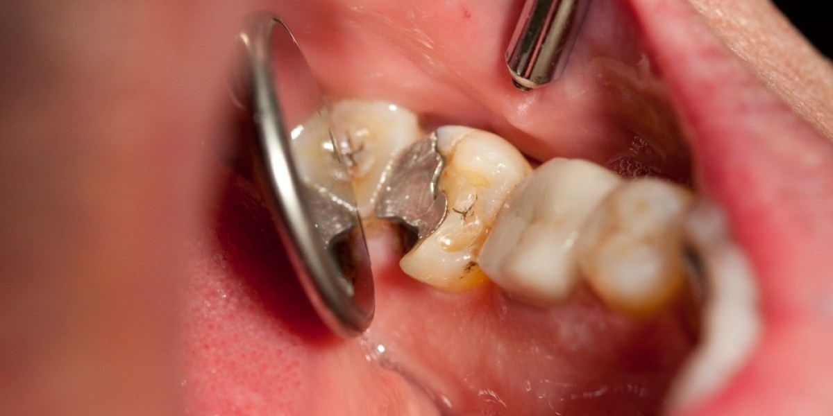 Tooth Filling Cost: What First-Time Patients Should Know