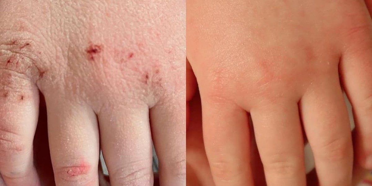 How Can the Right Eczema Treatment Improve Skin Barrier Health?