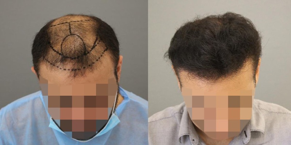 وداعاً للصلع: كيف أصبحت الرياض عاصمة الجمال لزراعة الشعر؟