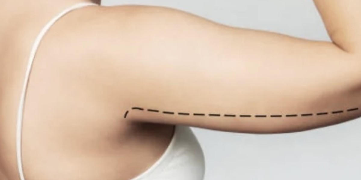 Arm Liposuction in Dubai Trusted by Locals and Expats