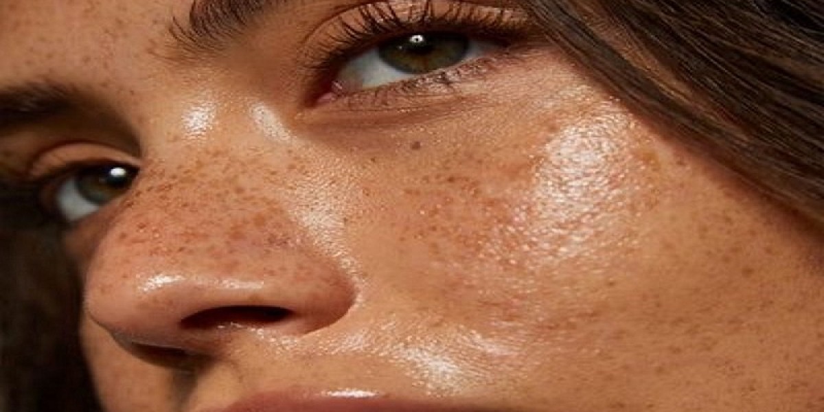 Top Dermatologist-Recommended Melasma Treatment in Islamabad