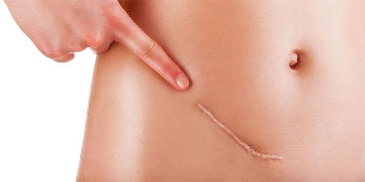 Effective Skin Tag Removal with Professional Care