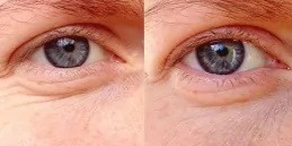 Eye Bag Removal in Islamabad: Recovery Time and Care Tips