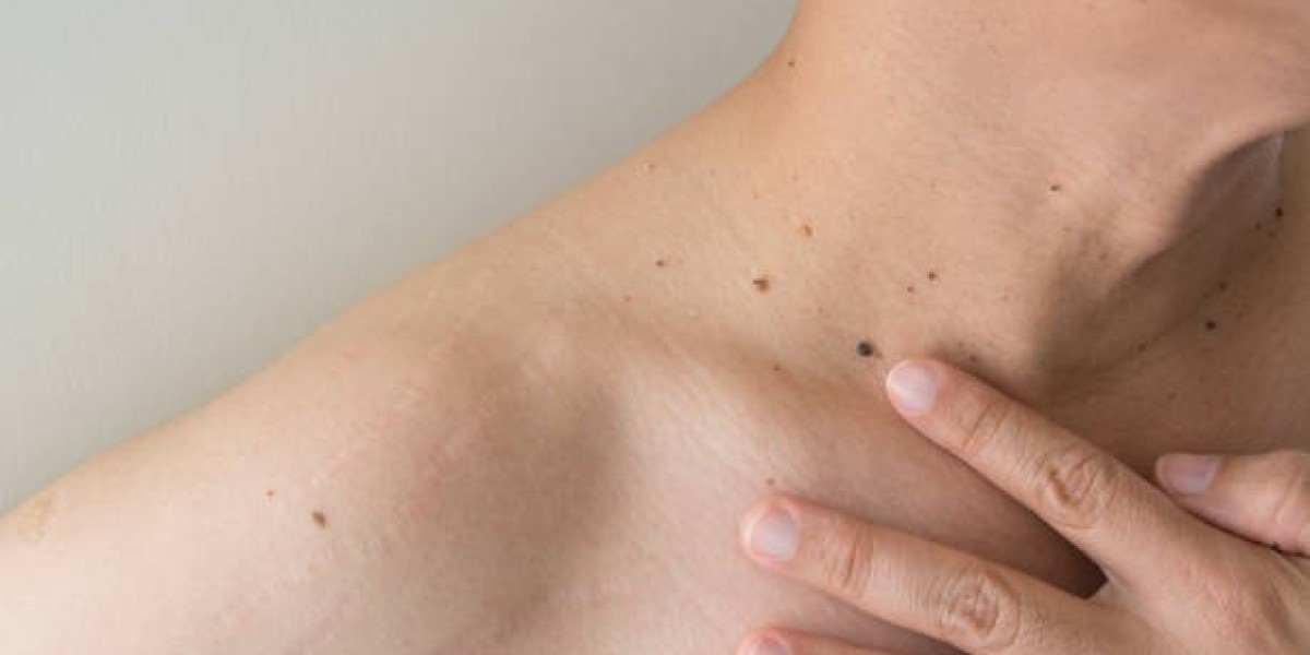 Natural Oils That Help Fade Skin Tags