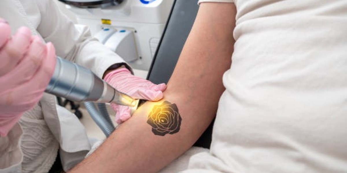 Professional Laser Tattoo Removal for Arms Now