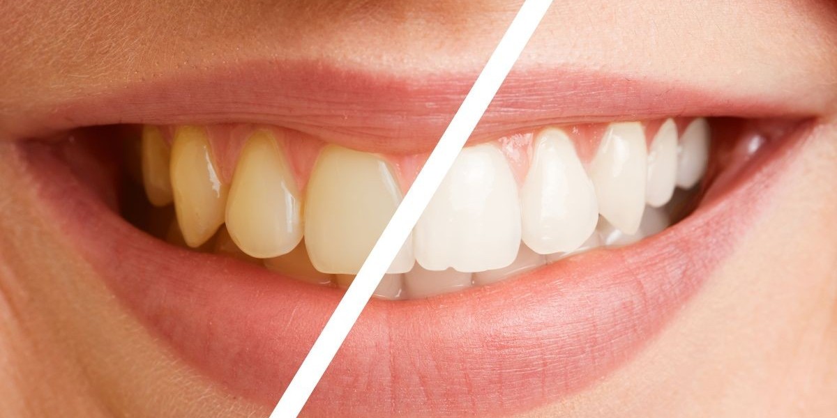Smart Teeth Whitening Cost Tips for a Brilliant Smile Transformation