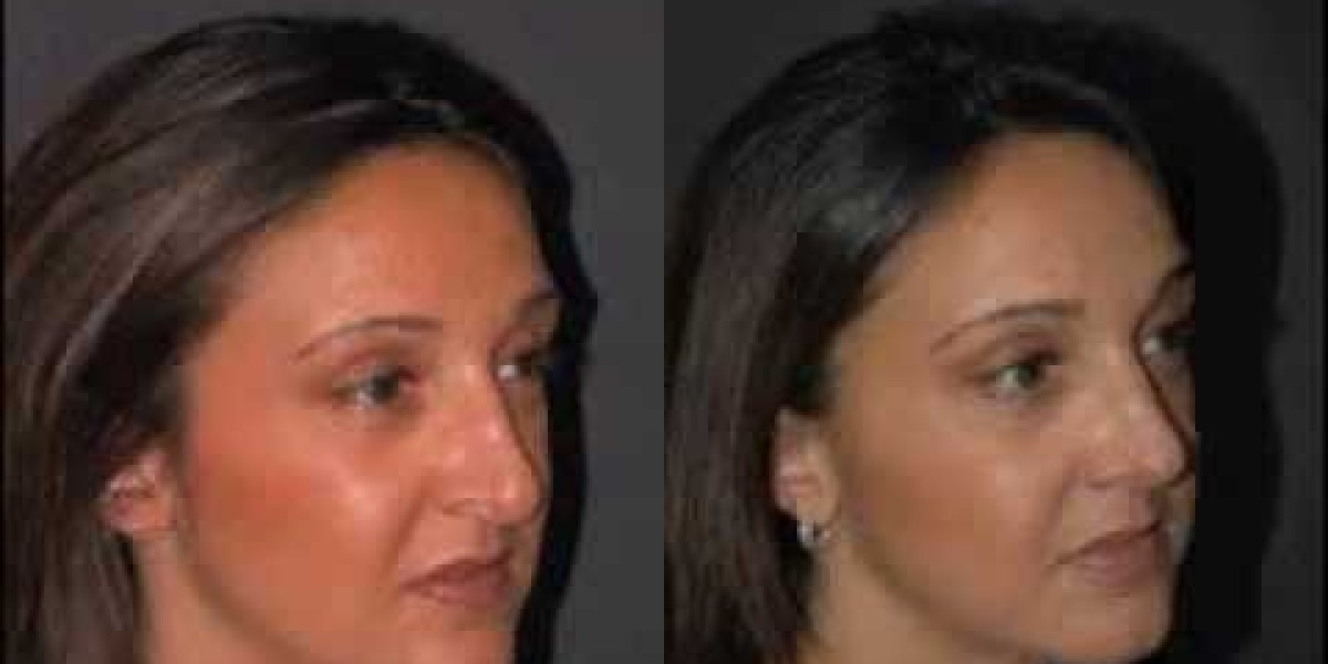 العودة للحياة الطبيعية بعد تجميل الأنف: جدول زمني من خبراء الرياض