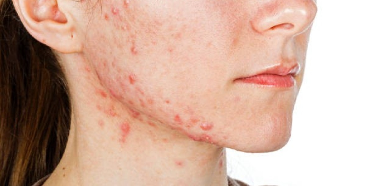 Pimples Treatment Guide for Clearer and Healthier Skin