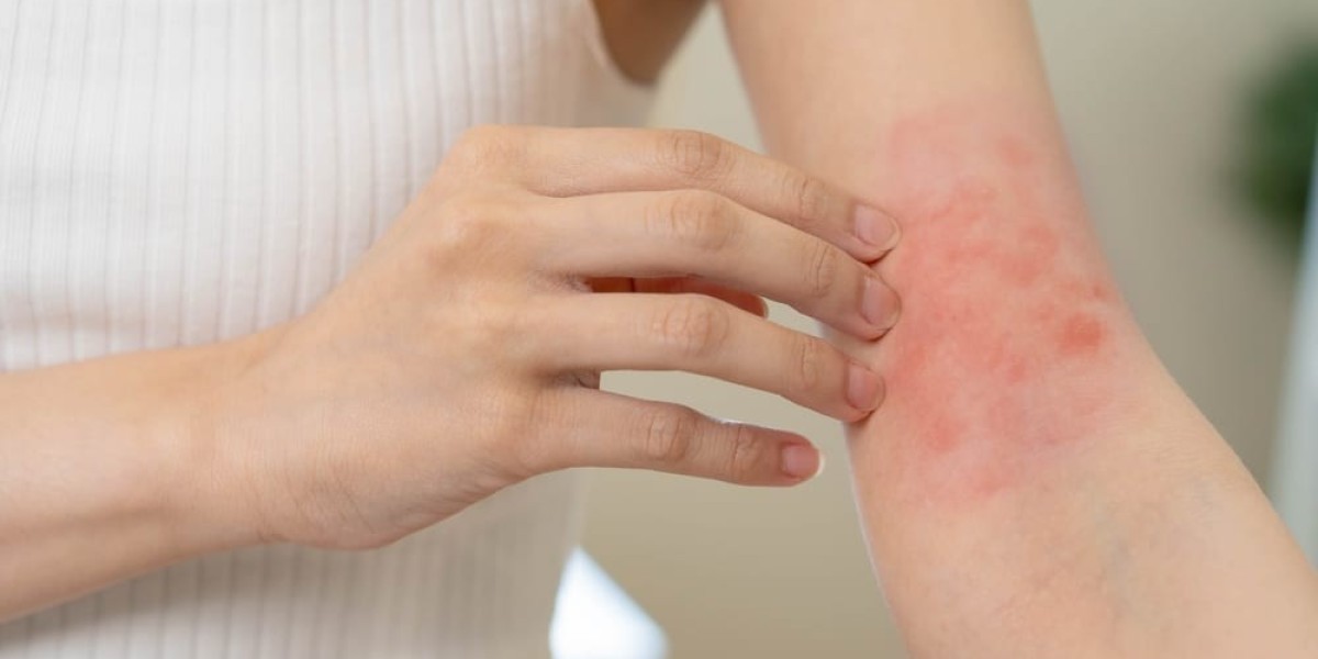 How Can the Right Eczema Treatment Improve Skin Barrier Health?