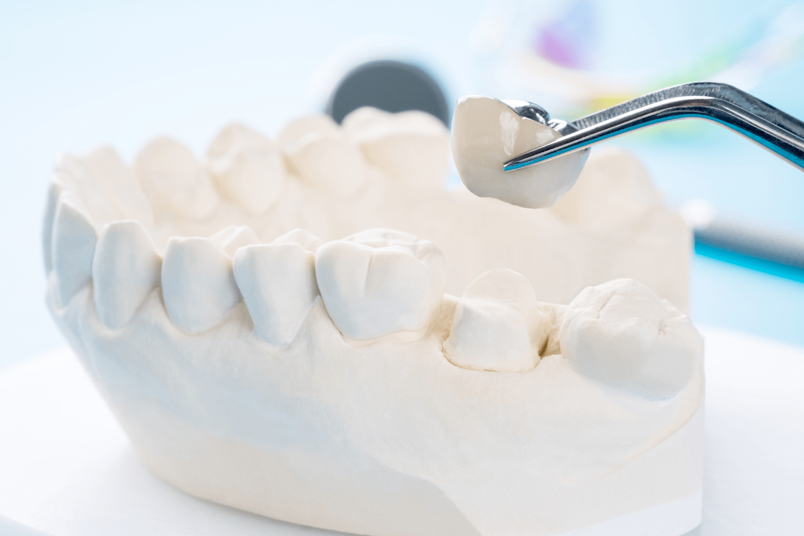 Comprehensive Guide to Dental Crowns in Geelong | Blog