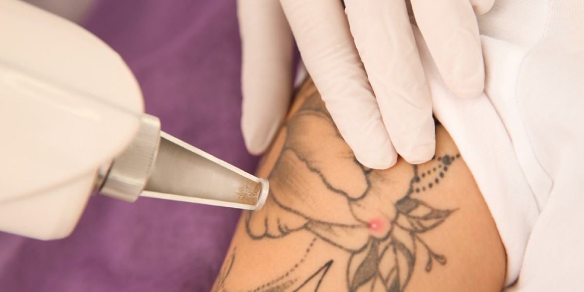 Laser Tattoo Removal delivers visible results that boost confidence fast