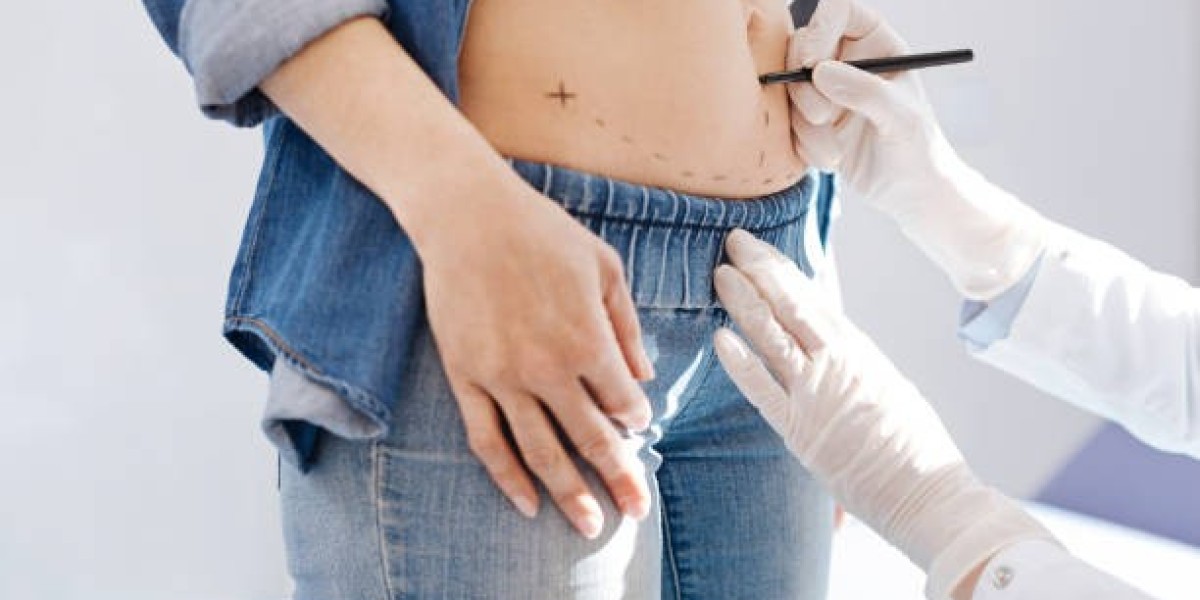 Liposuction Procedure for Buttock Contours