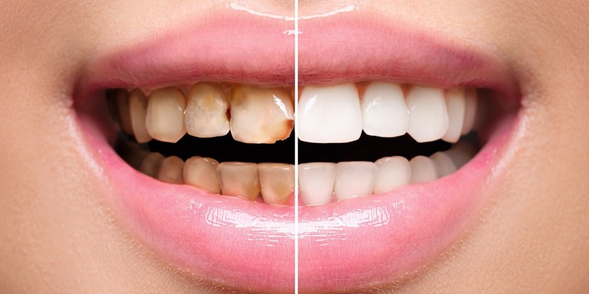 Teeth Scaling and Polishing in Islamabad: Best Time to Schedule Treatment