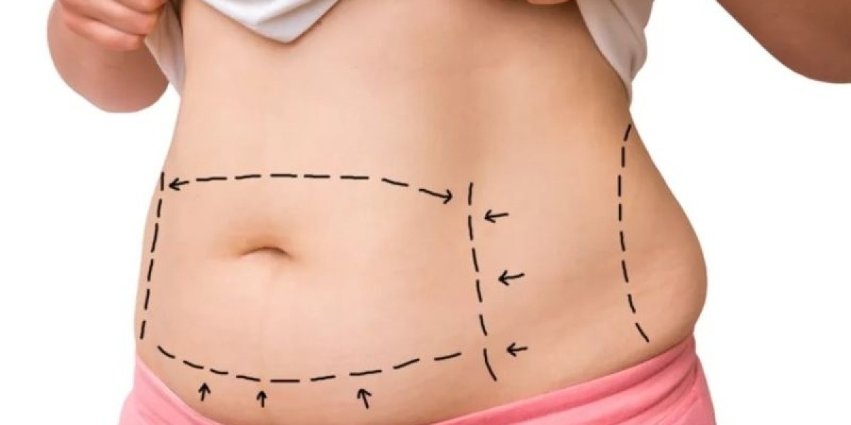 Mini Abdominoplasty: The Modern Solution for a Flatter Belly