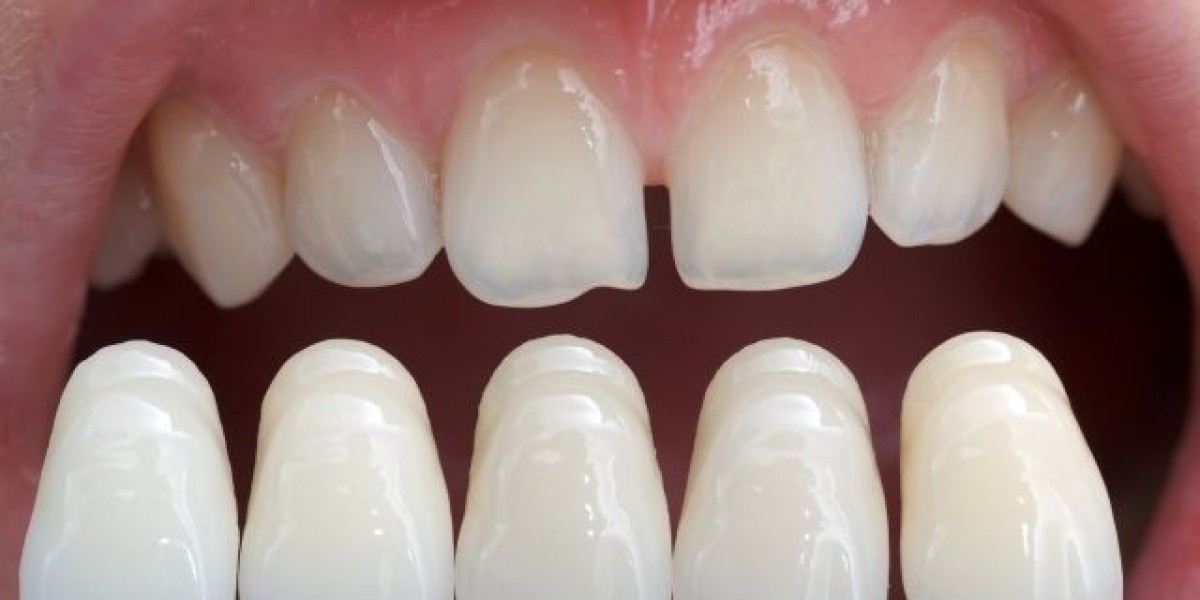 Reveal Stunning Teeth Instantly with Composite Veneers Magic