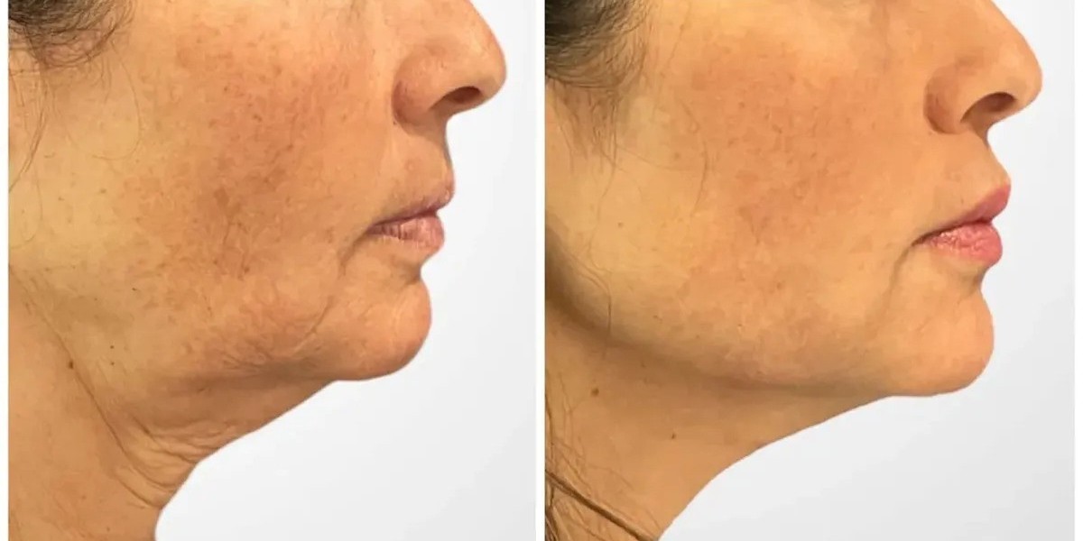 Why Best Plastic Surgeons in Dubai Recommend Thread Lift Procedures