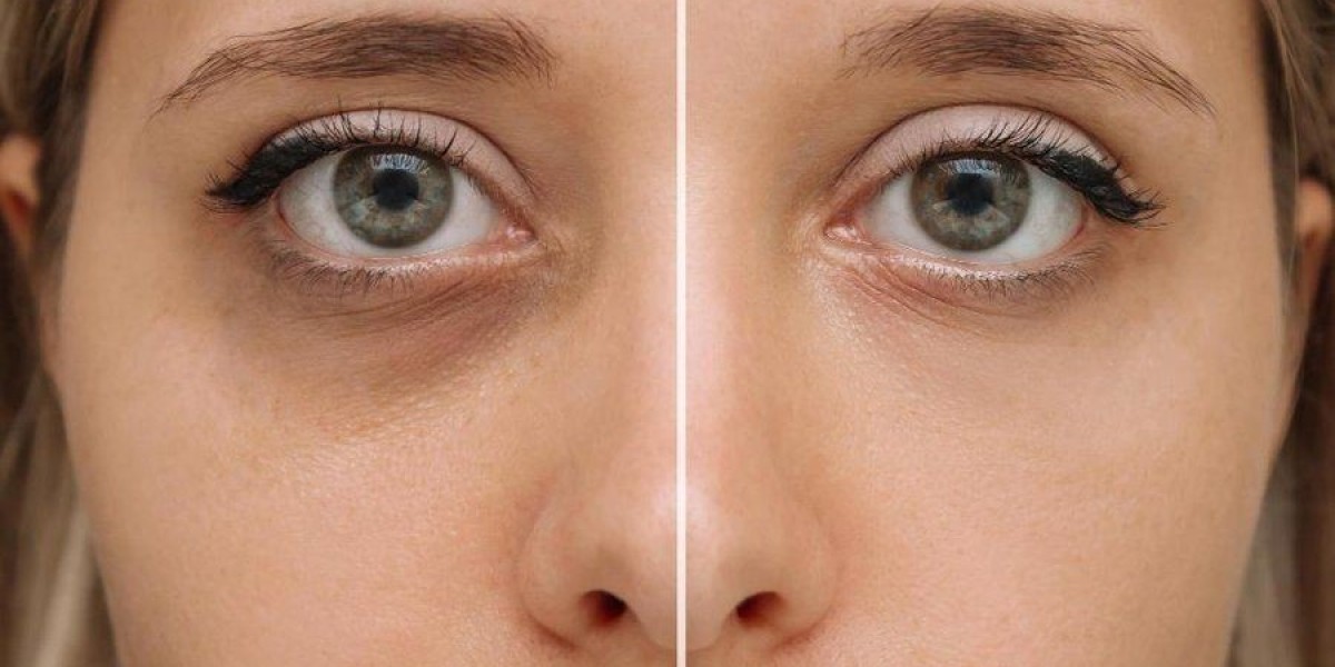 Comprehensive FAQ on Eyelid Surgery in Riyadh for First-Timers