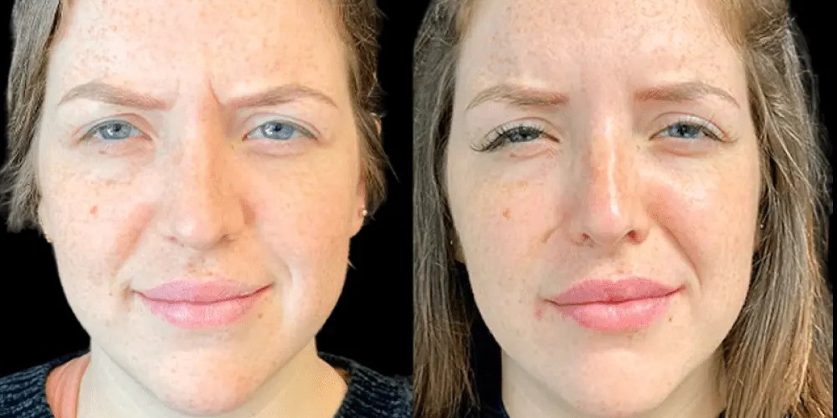 Best Plastic Surgeons in Dubai for Botox: What Sets the Experts Apart