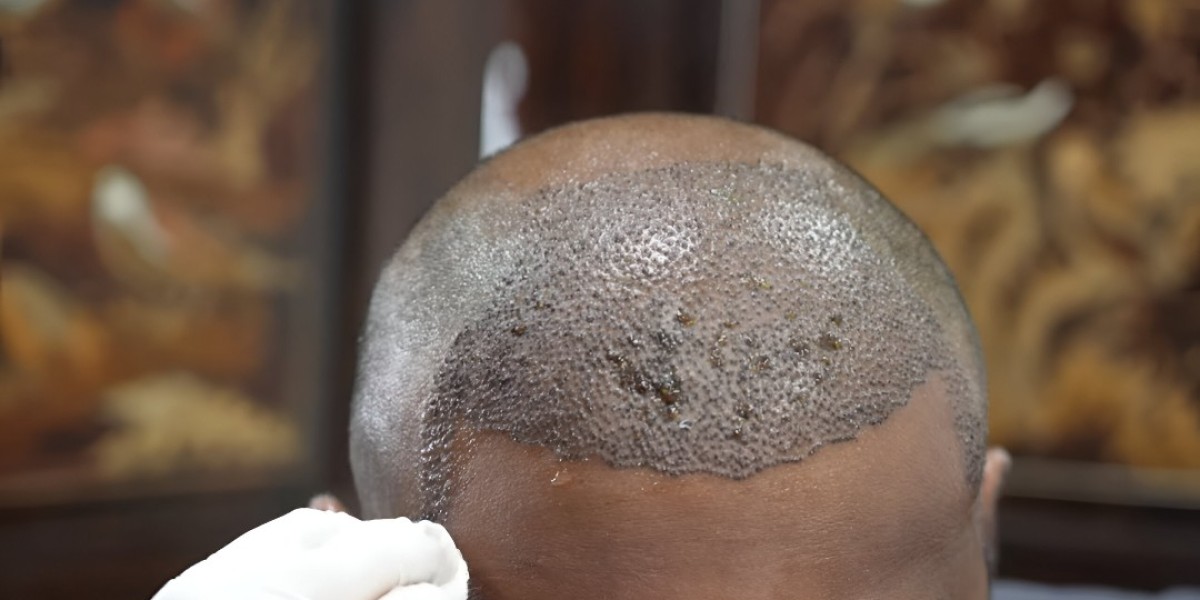 Hair Transplant in Islamabad: Complete Beginner’s Guide