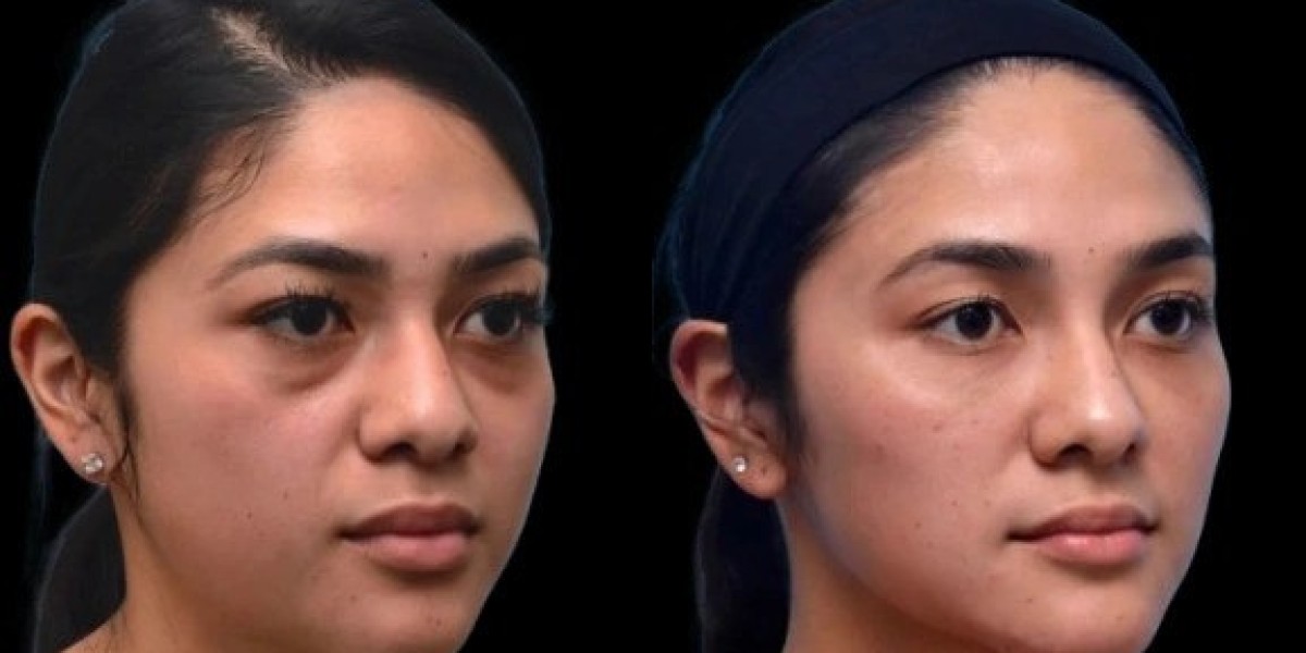 Safe and Effective Dark Circles Treatment from the Best Plastic Surgeon in Dubai