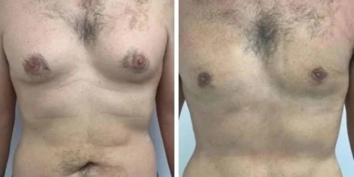 Gynecomastia Surgery in dubai for Transforming Chest Shape