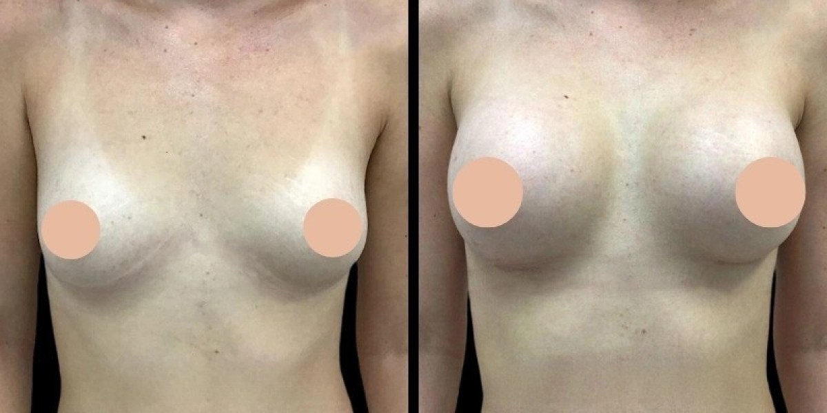 Importance of Follow-Ups with the Best Breast Augmentation Surgeons in Dubai
