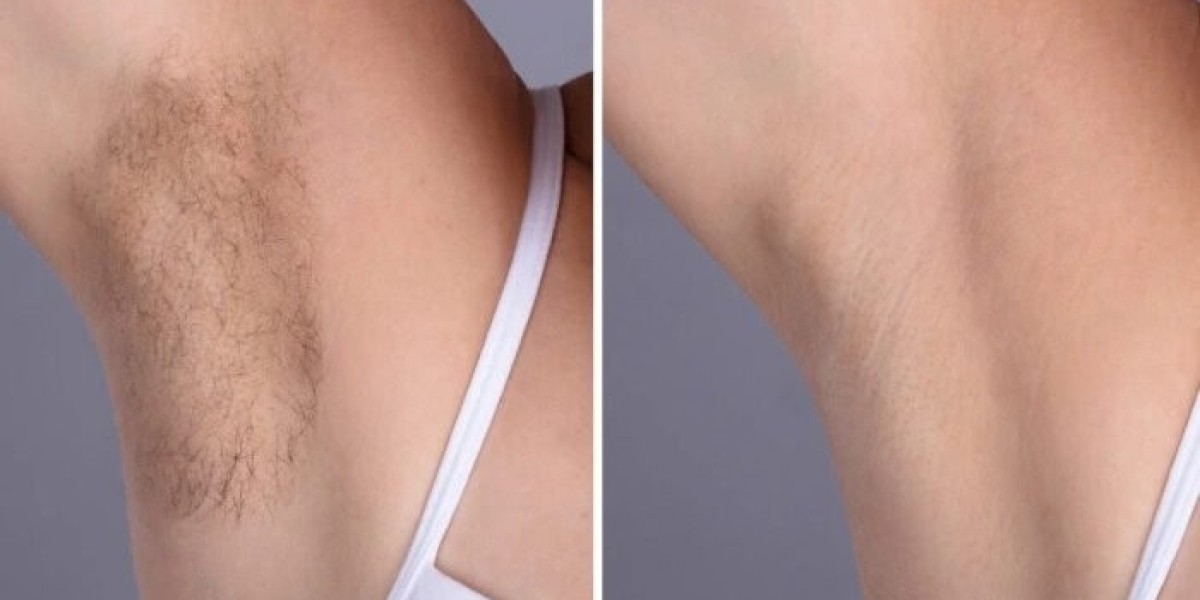Best Plastic Surgeon in dubai: Electrolysis Laser hair removal That Works