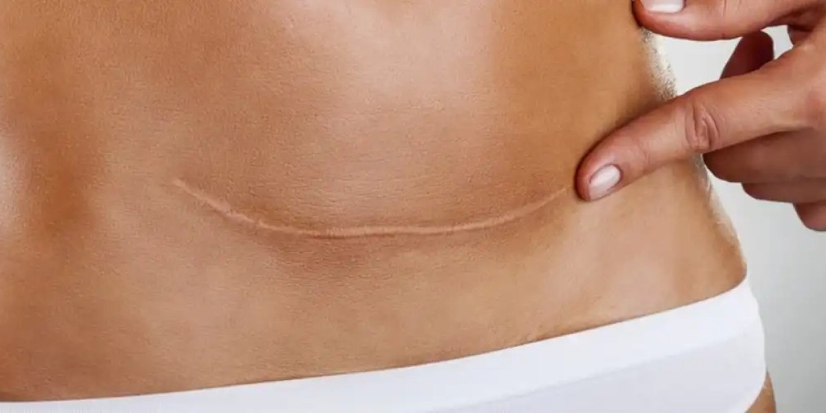 Why Scar Removal Is Viewed as Personalized Care