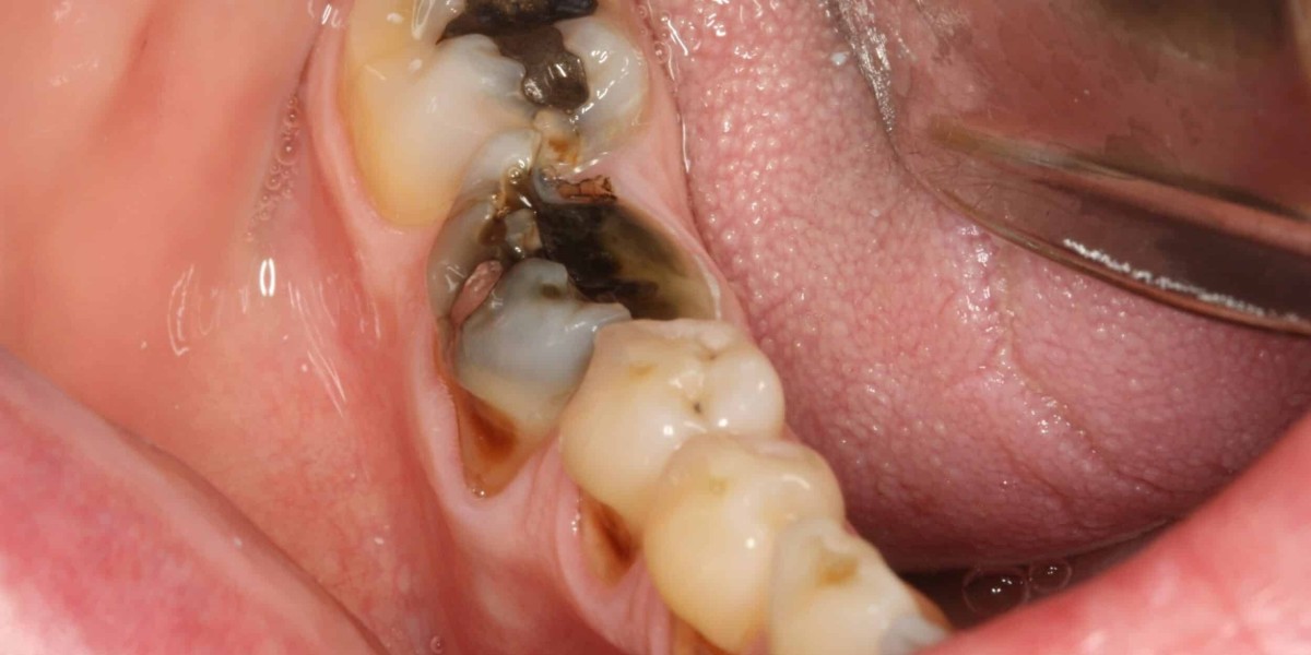 What Financial Details Should Be Reviewed Before Tooth Extraction?